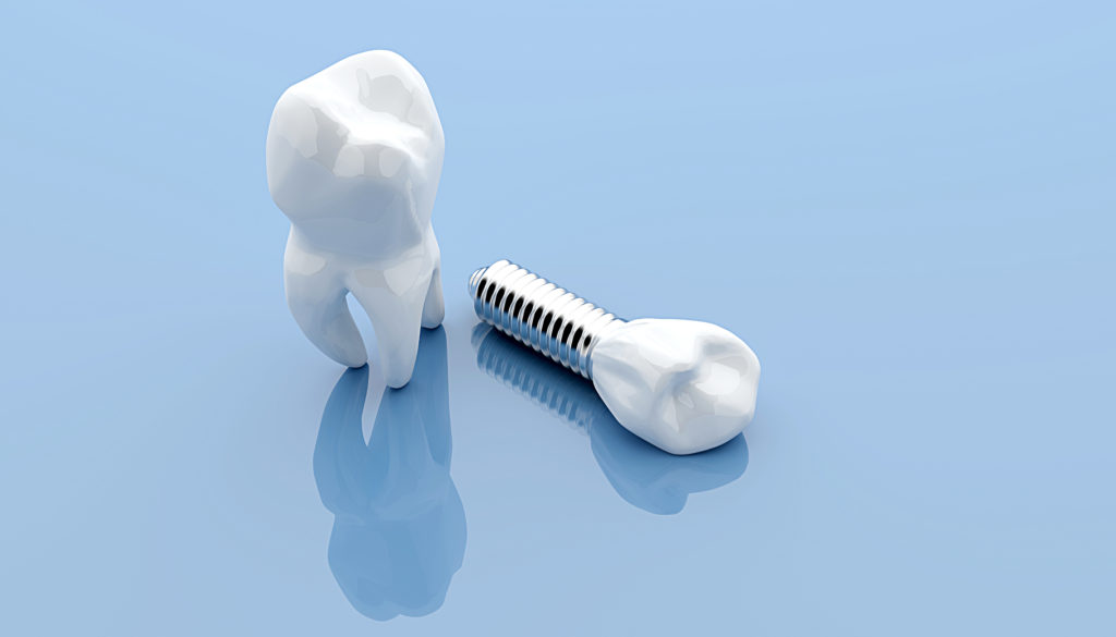 General dentistry dental implants